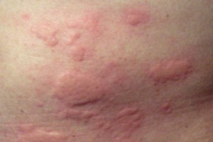 Bumps On Skin | Dorothee Padraig South West Skin Health Care